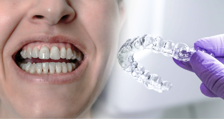 Achieve a Healthier Smile with Invisalign: The Clear Path to Dental Wellness